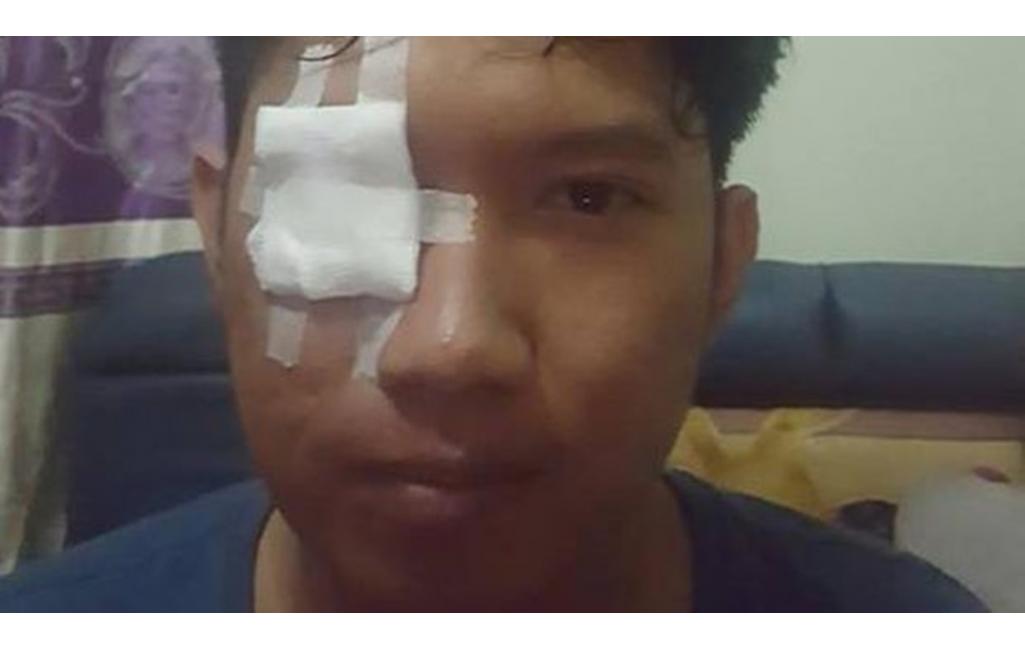 Lagi Asyik Motoran, Mata Rendhy Terkena Bara Rokok Pengendara Lain